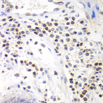 Immunohistochemistry of paraffin-embedded human colon using Swi2/SNF2 Polyclonal Antibody at dilution of 1:100 (40x lens).