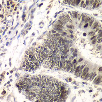 Immunohistochemistry of paraffin-embedded human colon carcinoma using Swi2/SNF2 Polyclonal Antibody at dilution of 1:100 (40x lens).