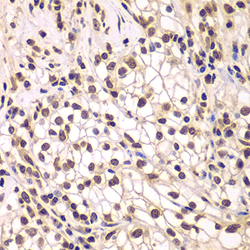 Immunohistochemistry of paraffin-embedded human kidney cancer using SMARCC1 antibody at dilution of 1:200 (400x lens).