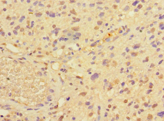 Immunohistochemistry of paraffin-embedded human glioma using PRMT3 Polyclonal Antibodyat dilution of 1:100