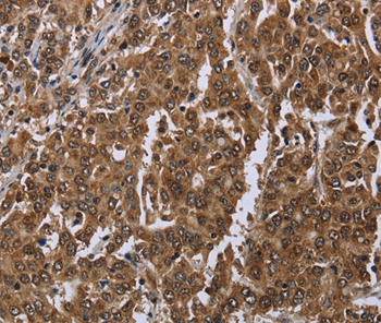 Immunohistochemical analysis of paraffin-embedded Human liver cancer tissue using at dilution 1/20.
