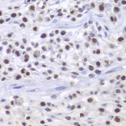 Immunohistochemistry of paraffin-embedded mouse cancer using HAT1 Polyclonal Antibody at dilution of 1:200 (400x lens).