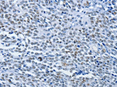 Immunohistochemistry of paraffin-embedded Human ovarian cancer tissue using HP1-beta Polyclonal Antibody at dilution 1/30.