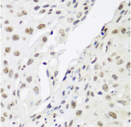 Immunohistochemistry of paraffin-embedded human lung cancer using HP1-gamma Polyclonal Antibody at dilution of 1:200 (40x lens).