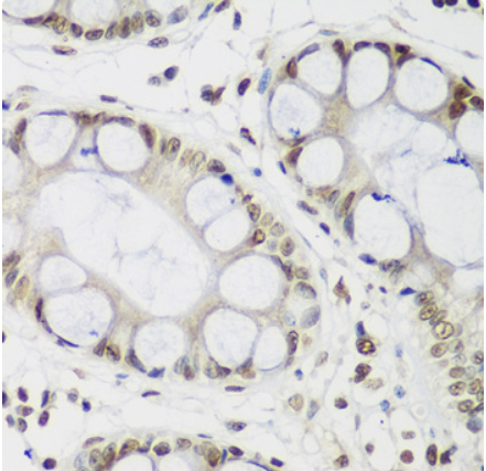 Immunohistochemistry of paraffin-embedded human gastric using HP1-gamma Polyclonal Antibody at dilution of 1:200 (40x lens).