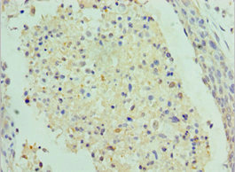 Immunohistochemistry of paraffin-embedded human cervical cancer at dilution of 1:100