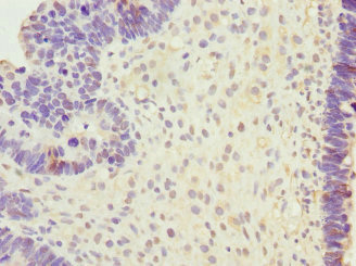 Immunohistochemistry of paraffin-embedded human ovarian cancer using SAP30 Polyclonal Antibody at dilution of 1:100