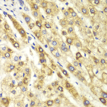 Immunohistochemistry of paraffin-embedded human liver cancer using CTBP1 Polyclonal Antibody at dilution of 1:100 (400x lens).