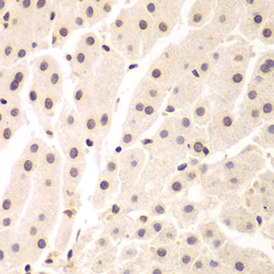 Immunohistochemistry of paraffin-embedded human liver cancer using UHRF2 Polyclonal Antibody at dilution of 1:200 (400x lens).