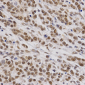 Immunohistochemistry of paraffin-embedded human stomach cancer using SMARCE1 Polyclonal Antibody at dilution of 1:200 (x400 lens).