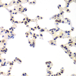 Immunohistochemistry of paraffin-embedded human breast cancer using RNF2 antibody at dilution of 1:200 (400x lens).