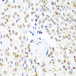 Immunohistochemistry of paraffin-embedded human lung cancer using  CTCF Polyclonal Antibody  at dilution of 1:100 (40x lens).
