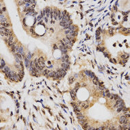 Immunohistochemistry of paraffin-embedded human rectal cancer tissue using Histone H3K14 Dimethyl Polyclonal Antibody at dilution of 1:200 (x400 lens)