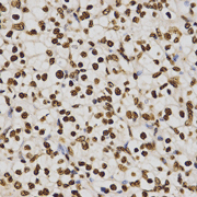 Immunohistochemistry of paraffin-embedded human kidney cancer tissue using H4K20me3 antibody at dilution of 1:200 (x400 lens).
