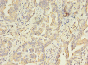 Immunohistochemistry of paraffin-embedded human lung cancer at dilution 1:100