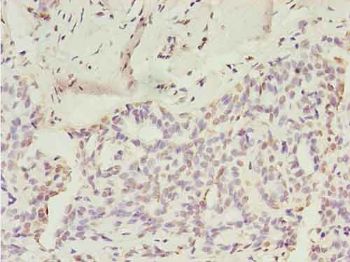 Immunohistochemistry of paraffin-embedded human glioma cancer at dilution of 1:100