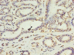 Immunohistochemistry of paraffin-embedded human breast cancer tissue using DAPK2 Polyclonal Antibody at dilution 1:100
