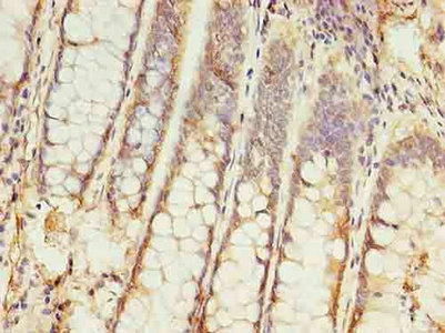 Immunohistochemistry of paraffin-embedded human colon cancer using DDX3X Polyclonal Antibody at dilution 1:100.