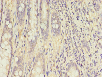 Immunohistochemistry of paraffin-embedded human colon cancer tissue using CKB Polyclonal Antibody at dilution 1:100