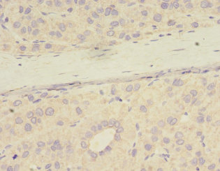 Immunohistochemistry of paraffin-embedded human liver cancer tissue at dilution 1:100