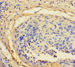 Immunohistochemistry of paraffin-embedded human cervical cancer at dilution 1:100