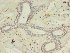 Immunohistochemistry of paraffin-embedded human breast cancer tissue at dilution 1:100