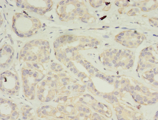 Immunohistochemistry of paraffin-embedded human breast cancer using VSIG2 Polyclonal Antibody at dilution 1:100