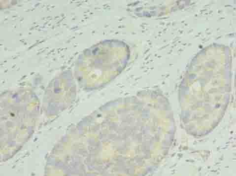 Immunohistochemistry of paraffin-embedded human gastric cancer using RDH12 Polyclonal Antibody at dilution of 1:100