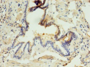 Immunohistochemistry of paraffin-embedded human lung tissue using ABHD3 Polyclonal Antibody at dilution 1:100