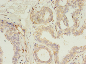 Immunohistochemistry of paraffin-embedded human breast cancer using RERG Polyclonal Antibody at dilution 1:100