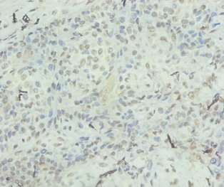 Immunohistochemistry of paraffin-embedded human mammary carinoma at dilution 1:100