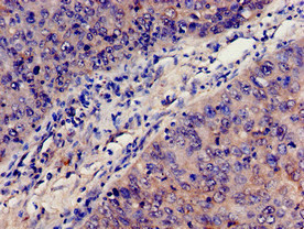 Immunohistochemistry analysis of human cervical cancer using C3 Polyclonal Antibody at dilution of 1:100