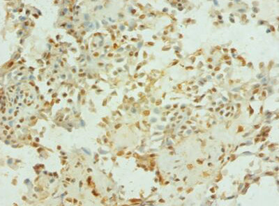 Immunohistochemistry of paraffin-embeded human breast cancer at dilution of 1:100