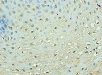 Immunohistochemistry of paraffin-embeded human esophageal cancer at dilution of 1:100