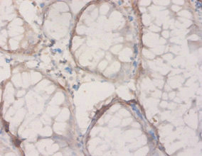 Immunohistochemistry of paraffin-embedded human colon cancer using HPD Polyclonal Antibody at dilution of 1:20