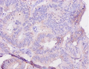 Immunohistochemistry of paraffin-embedded human colon cancer at dilution of 1:10