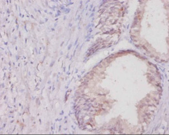 Immunohistochemistry of paraffin-embedded human colon cancer at dilution 1:20