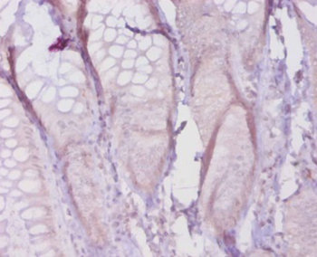 Immunohistochemistry of paraffin-embedded human colon cancer at dilution 1:50