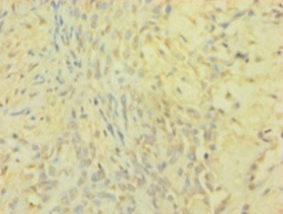 Immunohistochemistry of paraffin-embedded human breast cancer using TIMP1 Polyclonal Antibody at dilution 1:100.