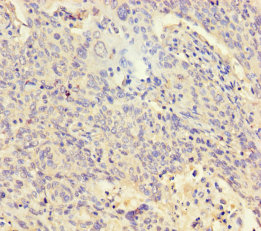 Immunohistochemistry of paraffin-embedded human cervical cancer at dilution of 1:100