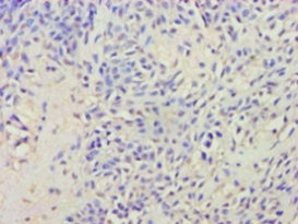 Immunohistochemistry of paraffin-embedded human breast cancer at dilution 1:100