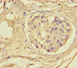 Immunohistochemistry of paraffin-embedded human breast cancer using DFNA5 Polyclonal Antibody at dilution of 1:100