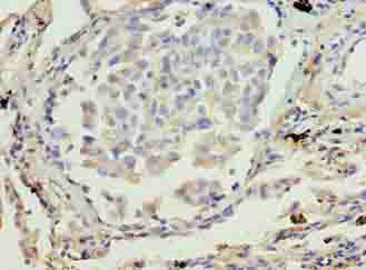 Immunohistochemistry of paraffin-embedded human lung cancer at dilution of 1:100