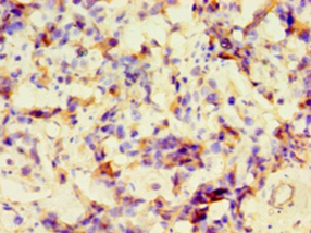 Immunohistochemistry of paraffin-embedded human bladder cancer using GRA1 Polyclonal Antibody at dilution 1:100