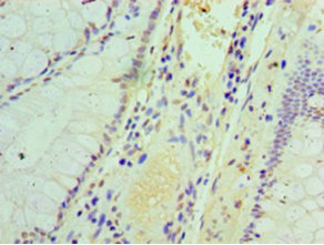 Immunohistochemistry of paraffin-embedded human colon cancer using IFIT3 Polyclonal Antibody at dilution 1:100