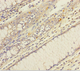 Immunohistochemistry of paraffin-embedded human colon cancer using PTPMT1 Polyclonal Antibody at dilution 1:100