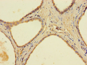 Immunohistochemistry of paraffin-embedded human prostate cancer at dilution of 1:100