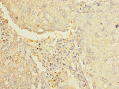 Immunohistochemistry of paraffin-embedded human lung cancer using AARSD1 Polyclonal Antibody at dilution of 1:100