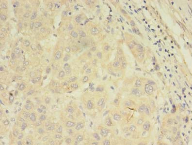 Immunohistochemistry of paraffin-embedded human liver cancer using ABCB5 Polyclonal Antibody at dilution of 1:100