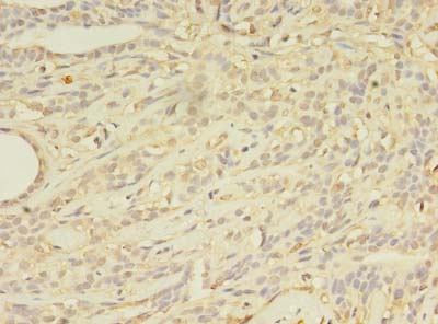 Immunohistochemistry of paraffin-embedded human breast cancer using ABCB5 Polyclonal Antibody at dilution of 1:100